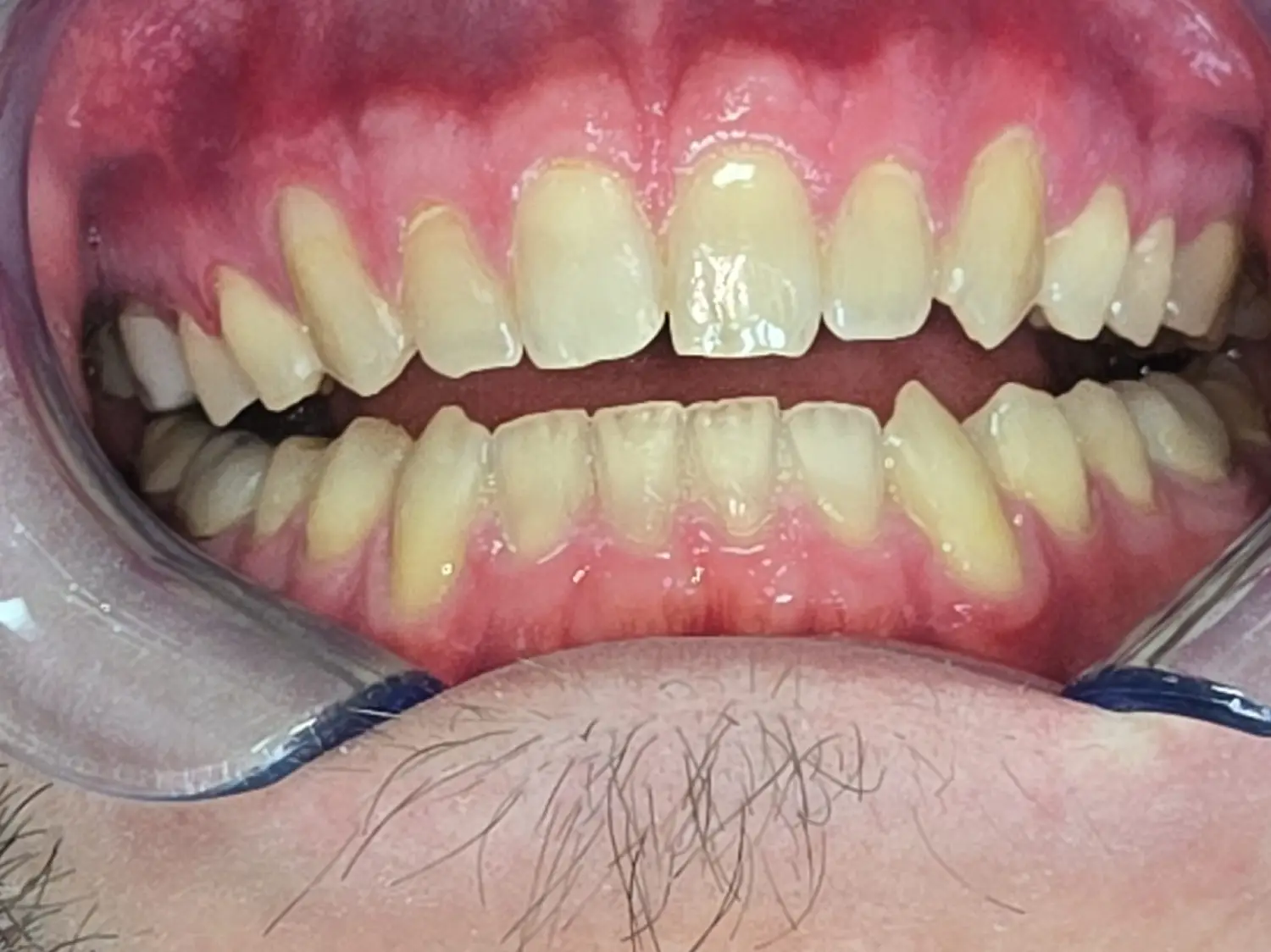 Invisalign-teeth-treatment-after