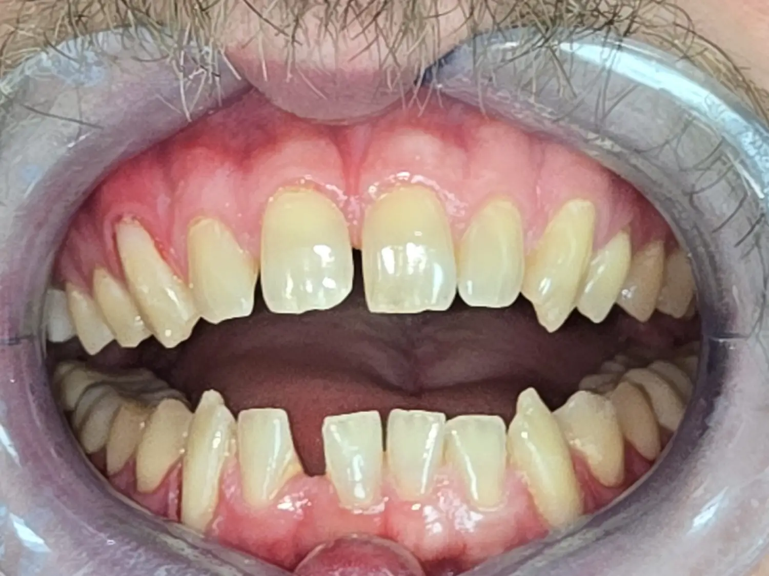 Invisalign-teeth-treatment-before